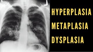 Hyperplasia Metaplasia amp Dysplasia Explained Cancer Biology [upl. by Troth]