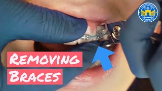 Process of Removing Braces [upl. by Aleekat]