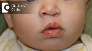 How to manage Cleft Palate and Lip Scar  Dr Surindher D S A [upl. by Alyled]