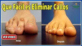 Que Fácil es Eliminar Callos en Pies y Manos Con Remedios Naturales [upl. by Wardlaw809]