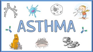 Asthma  Pathogenesis Types Clinical Presentation Morphology Diagnosis and Treatment [upl. by Charles]