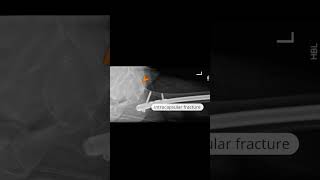 Intramedullary femoral nail with subcapital neck of femur fracture shoets [upl. by Dickerson174]