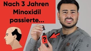 Haarausfall stoppen mit Minoxidil  Meine 3 Jahre Minoxidil Erfahrung [upl. by Hsu]