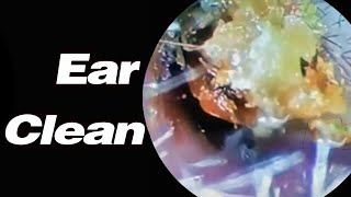 Ear Picking Ears That Have Not Been Cleaned In 20 Years Earwax Is Very HighASMRearwax [upl. by Mallissa]