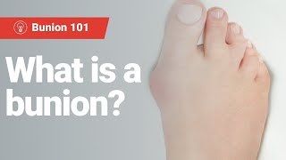 What is a bunion  Learn What Causes Bunions and How to Spot Symptoms [upl. by Amoreta]