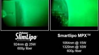 Video of Laser Liposuction Comparing SlimLipo vs SmartLipo and Lipotherme [upl. by Trixi]