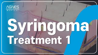 AGNES  Treatment Syringoma Treatment 1 ⚡️✨ [upl. by Uolyram]