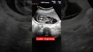 Cystic hygroma anomalyscan [upl. by Vanhook]