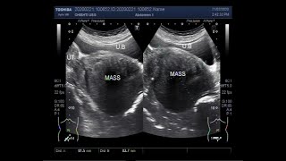 Ultrasound Video showing a large cervical mass [upl. by Alberta164]