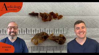 VERY FULL EAR CANAL amp SATISFYING EAR WAX REMOVAL  EP855 [upl. by Elburt901]