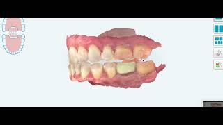 Mandibular Advancement Side Effect [upl. by Ahsienot]