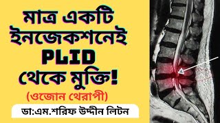 Disc Bulge Treatment Without Surgery  PLID Disc Herniation  DrMSharif Uddin Liton [upl. by Aseram]