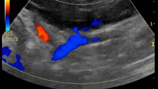 portosystemic shunt through R gastric vein in a dog [upl. by Puduns]