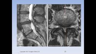 Lumbar Spinal Stenosis Cauda Equina Syndrome Sciatica amp Disc Herniation An Advanced Lecture [upl. by Alor454]