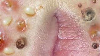 😱Blackhead extraction facial cleansing and blackhead removal Extracción espinillas limpieza facial [upl. by Blondelle324]