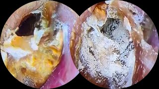 Thick fungus dry earwax removal asmrearwax 22 [upl. by Gonzales]