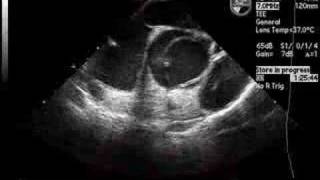 Dissection of Ascending Aorta on Echocardiogram [upl. by Jannelle]