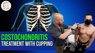 Costochondritis Treatment with Cupping [upl. by Sikata95]