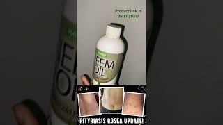 How To Cure Pityriasis Rosea😲 pityriasisroseatreatment pityriasisrosea neemoil [upl. by Coates]