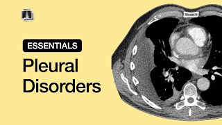 Pleural Disorders  Chest Radiology Essentials [upl. by Eirtemed936]