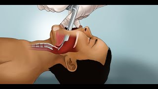 Pediatric Endotracheal Intubation by J Nagler et al  OPENPediatrics [upl. by Aemat]