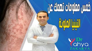 👈 خمس معلومات تهمك عن التينيا الملونة  Pityriasis versicolour 👩‍🏫 [upl. by Rabin]