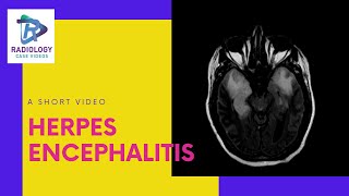 Herpes encephalitis MRI temporal hyperintensities Umamaheshwar Reddy V [upl. by Nnyliram]