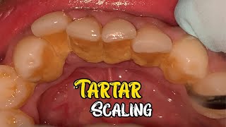 Deep Cleaning With HEAVY Tartar Build Up At The Dentist [upl. by Kirschner]