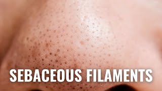 How To Get Rid of Sebaceous Filaments QUICKLY [upl. by Yeldoow]