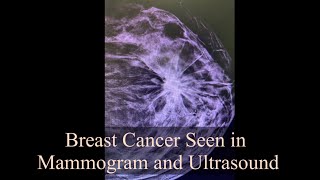 Breast Cancer Seen in Mammogram and Ultrasound [upl. by Akila]