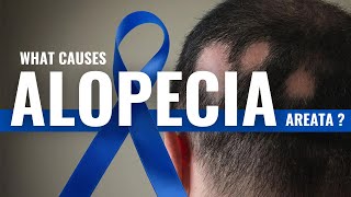 What Causes Alopecia Areata Explained By DrAsif [upl. by Tezzil212]