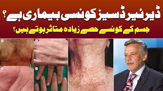 What is Darier Disease  Treatment of Dariers Disease  Keratosis Follicularis  Dr Raheel Karim [upl. by Atinaujnas]