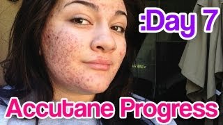 Day 7 Accutane SEVERE Acne Update [upl. by Sosna]