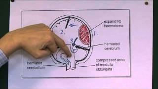 Head Injuries 9 Tentorial herniation [upl. by Ostraw241]