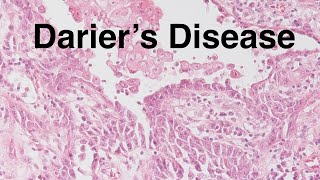 Dariers Disease  Pathology mini tutorial [upl. by Spencer]