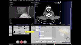 What is a CT Angiogram CTA of the Heart [upl. by Barling]