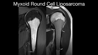 Myxoid Round Cell Liposarcoma [upl. by Bastian]