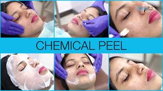 Chemical Peel  Chemical Peel for Acne  Chemical peel Before After Zolie Skin clinic [upl. by Ettenwahs325]