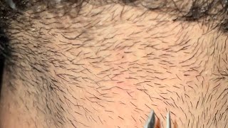 ASMR HAIR REMOVAL DOBAL INGROWN HAIR [upl. by Yrekaz]