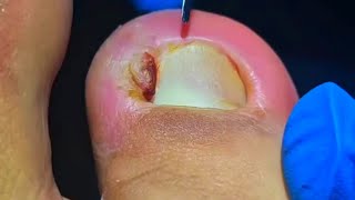 Patient Feels Instant Relief After Pedicurist Pulls Out Massive Ingrown Toenail [upl. by Jahncke]