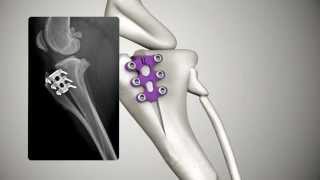 Tibial Tuberosity Advancement TTA RAPID [upl. by Nnel815]