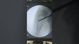 aneurysmal bone cyst curopsy [upl. by Okime]