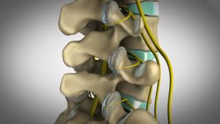 Orlando Chiropractic  Custom 3D animation visualizing facet syndrome and how chiropractic can help [upl. by Birchard]