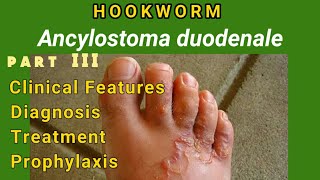 Hookworm  Ancylostomiasis Clinical Features Diagnosis Treatment Prophylaxis  AM Biologie Notes [upl. by Ynohtona]