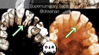 Supernumerary Tooth Removal from Palate Step by Step [upl. by Gabriellia]