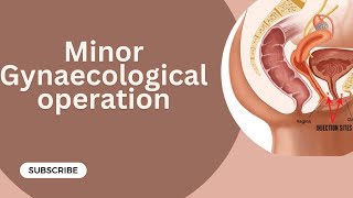 Minor Gynaecological operations  Gynaecology Lecture  part 18 [upl. by Niroc]