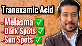 3 BEST Tranexamic Acids for Melasma and Discoloration not sponsored [upl. by Noed836]