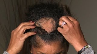 What Is Causing This Woman’s Extreme Hair Loss [upl. by Ahseem]