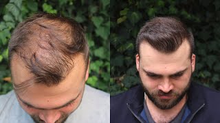 Hair Transplant Result with 3040 Grafts  EXTREME TRANSFORMATION from 0 days to 10 Months [upl. by Curhan138]