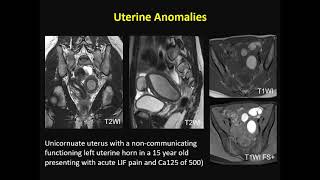 ISMRM MR Academy  Endometrial and Cervical Cancer [upl. by Cordy]